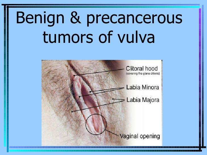 Hard spot in vulva