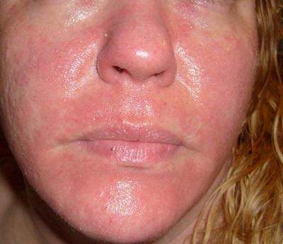 Facial rash hives
