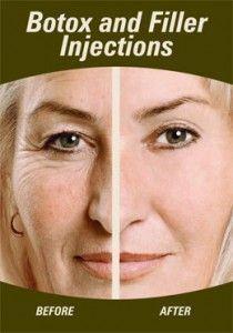 Mouse reccomend Botox facial reduce vancouver wrinkle