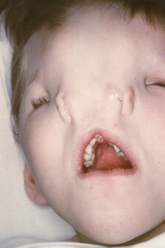 Median facial cleft syndrome