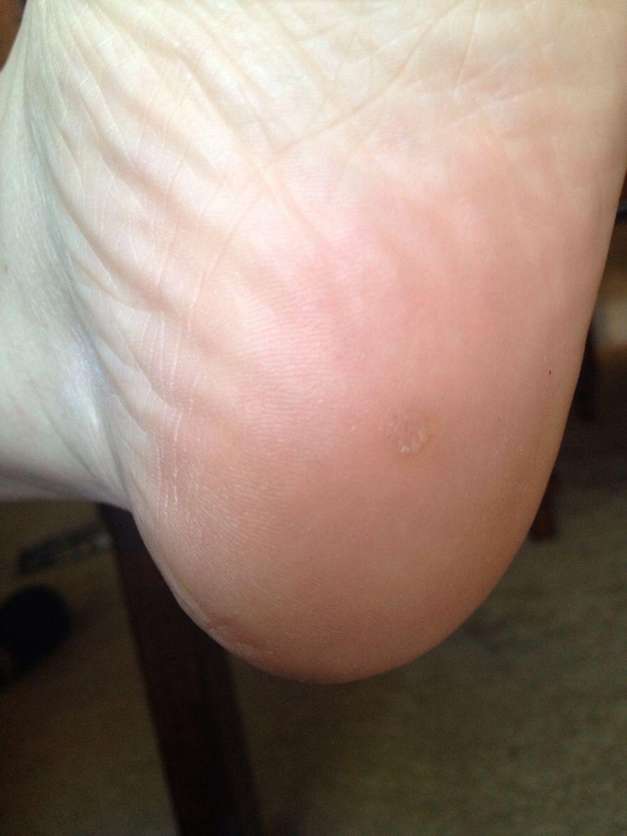 Planters wart on bottom of left foot