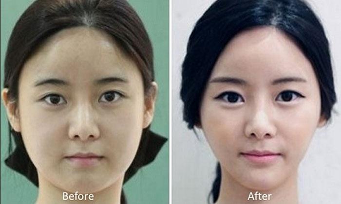 Doughboy reccomend Asian plastic surgery pictures