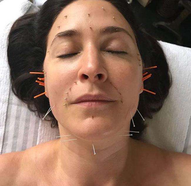 best of Acupuncture pictures Facial