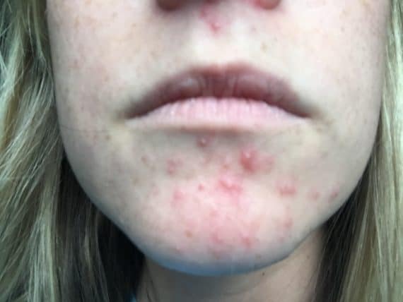 best of Eczema zinc Facial