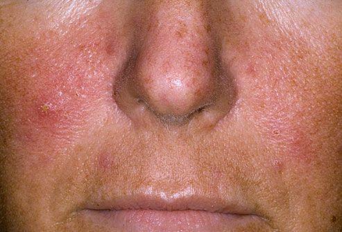 best of Hives Facial rash