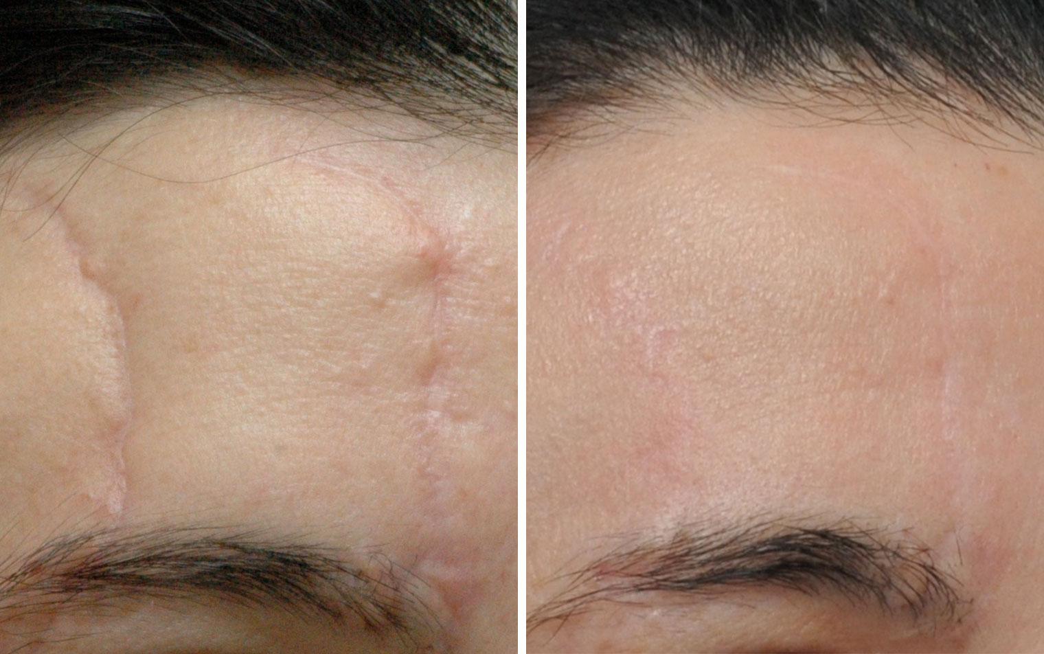 best of Reconstructive surgery scars Facial