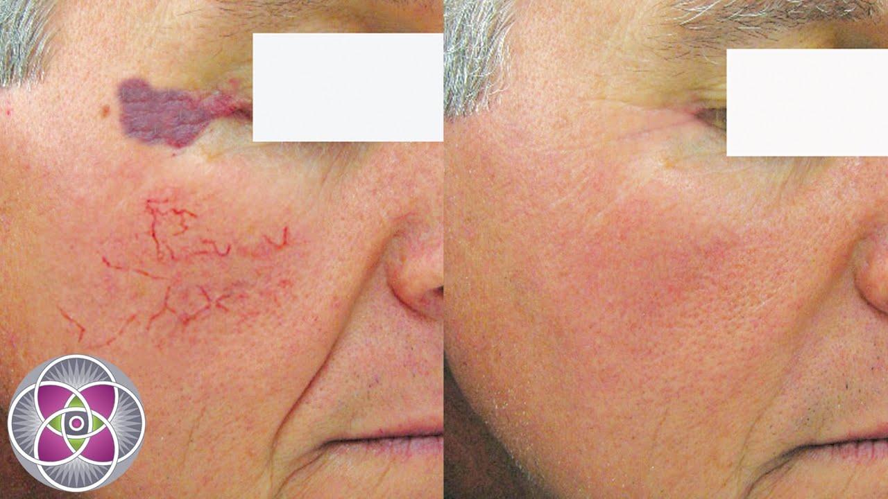 best of Cost removal Facial vein
