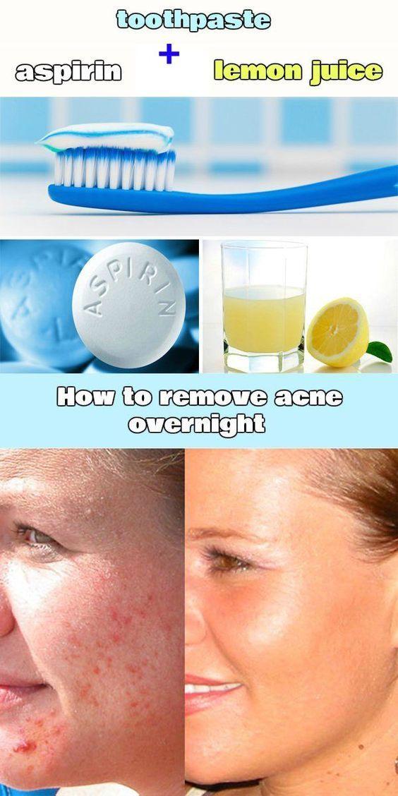 Fastest Way To Get Rid Of Zits Overnight Pron Pictures 2018