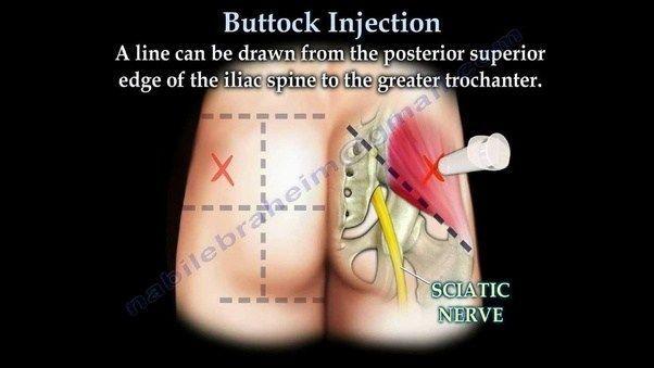 best of Ass butt injection needle Im