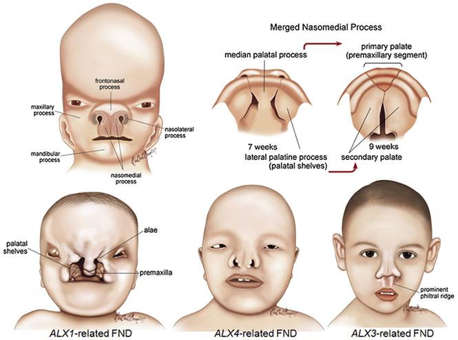 best of Cleft syndrome facial Median