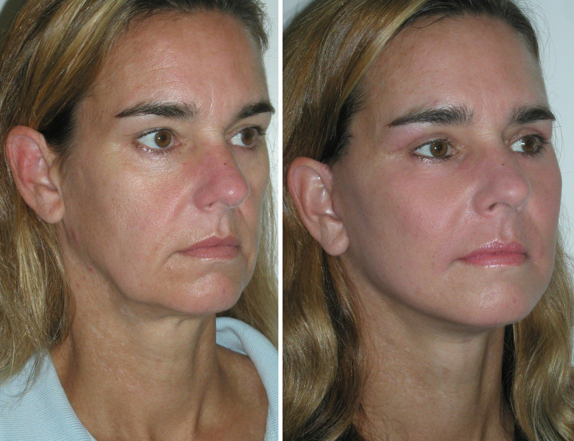 best of After lift facial numbness Permanent