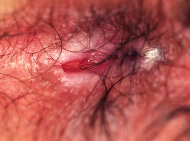best of Anal fissure of ulcer Picture acute