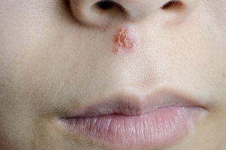 best of Lesions Recurring cheek facial nose