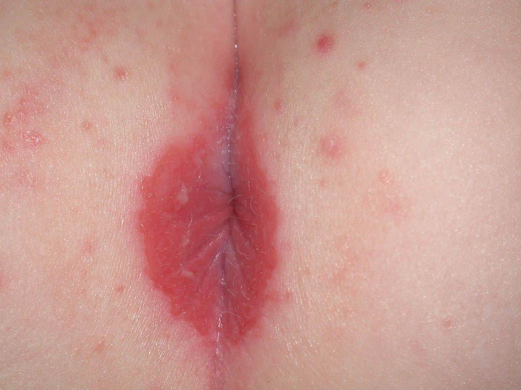 best of Painful anus around Red rash